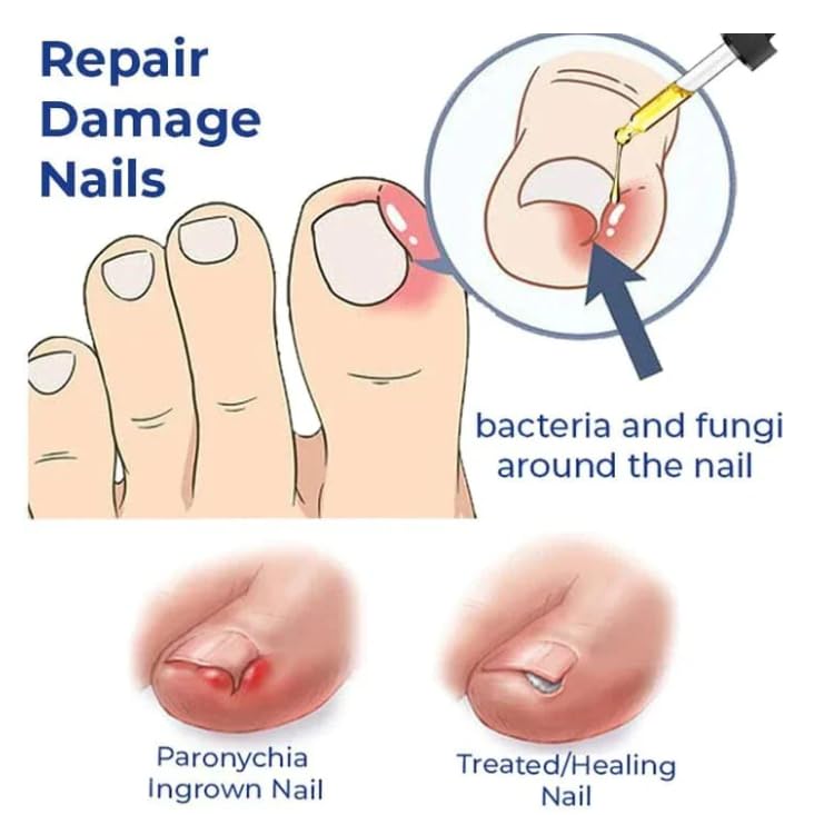 Anti Paronychia Relief Oil (Buy 1 get 1 FREE) š„š„
