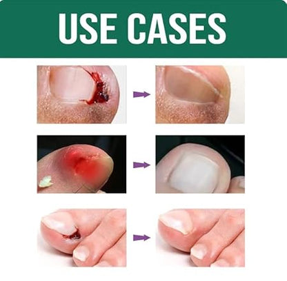 Anti Paronychia Relief Oil (Buy 1 get 1 FREE) 🔥🔥