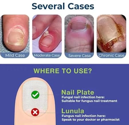 Anti Paronychia Relief Oil (Buy 1 get 1 FREE) 🔥🔥