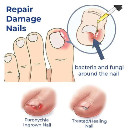 Anti Paronychia Relief Oil (Buy 1 get 1 FREE) 🔥🔥