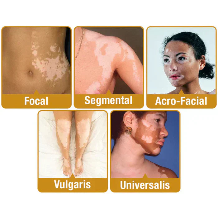 VitiGO Bee Venom Corrector Cream – Buy 1 Get 1 Free ✅